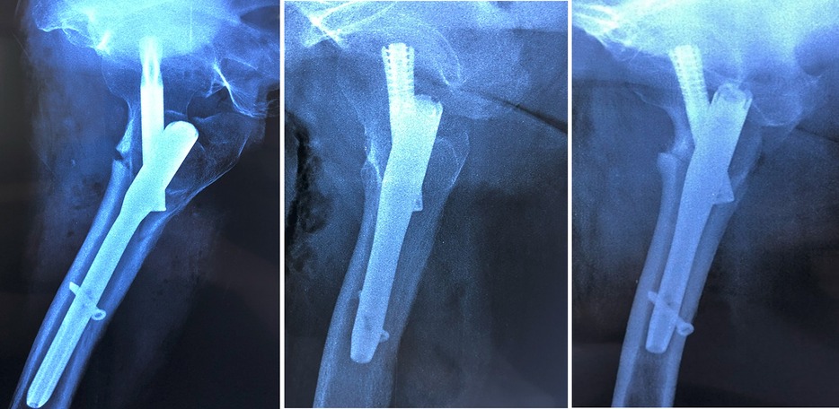 X-ray images of a fractured bone with surgical metal rods and screws inserted for stabilization. The three images show different angles of the implanted hardware within the bone structure.