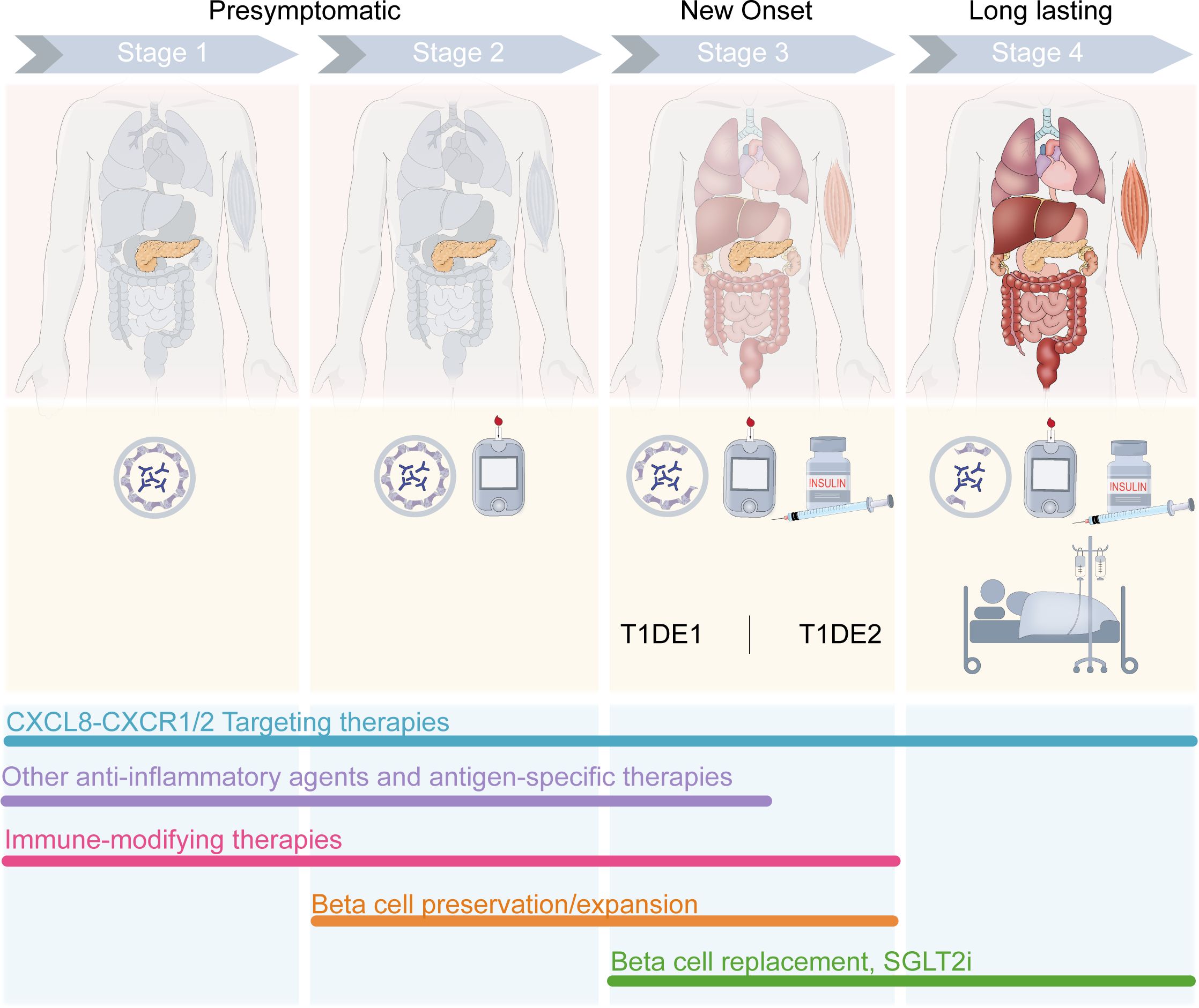 Diagram illustrating the progression and treatment strategies for diabetes across four stages: Stage 1 and 2 (Presymptomatic), Stage 3 (New Onset), and Stage 4 (Long Lasting). Stage 1 and 2 show a body outline and a cell diagram. Stage 3 adds a glucose meter and insulin vial. Stage 4 includes a person in a hospital bed. Treatment options are shown below, including targeting therapies, immune-modifying therapies, beta cell preservation, and replacement strategies.