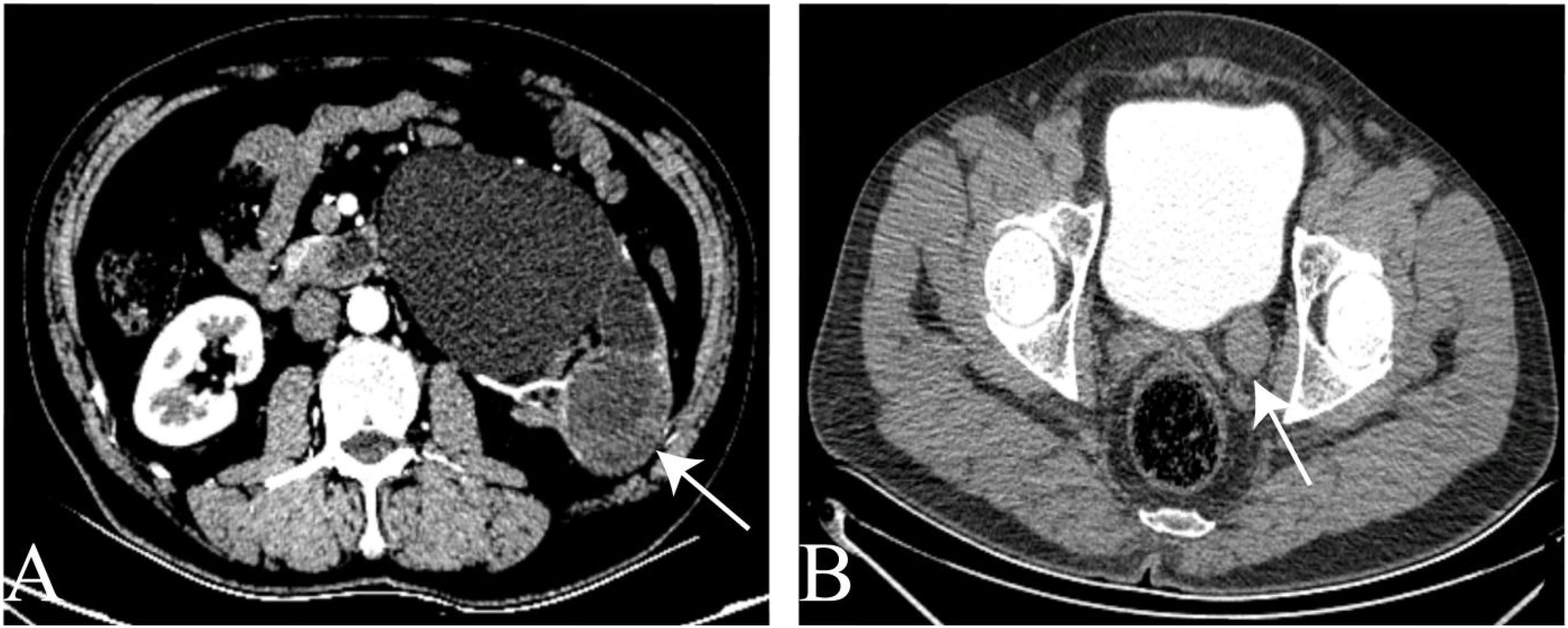 CT scans showing axial views of the abdomen and pelvis. Panel A highlights a large mass in the abdominal area with an arrow pointing to it. Panel B indicates another region of interest in the pelvic area with a similar arrow.