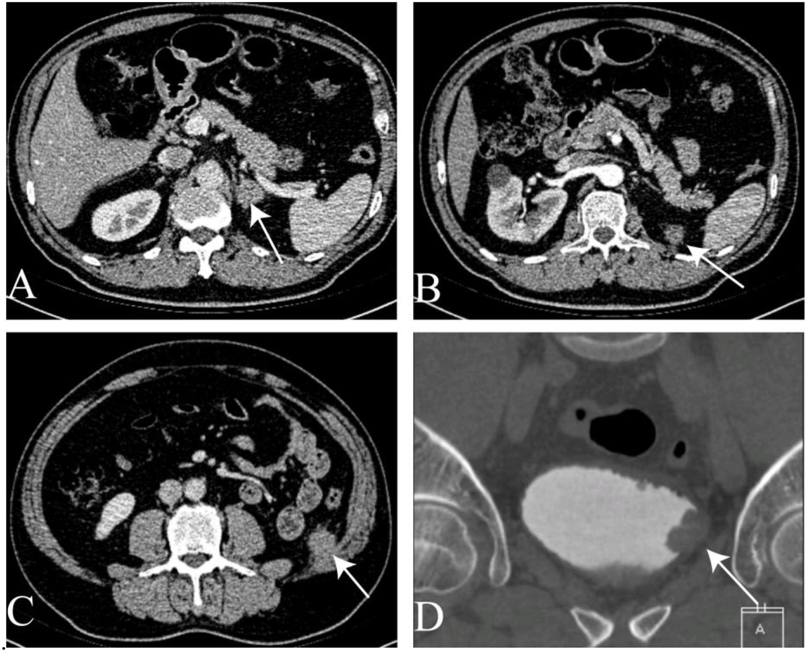 CT scan images showing cross-sectional views of the abdomen. Image A displays an arrow pointing to an area near the kidney. Image B highlights a different abdominal section with an area of interest marked by an arrow. Image C also has an arrow indicating a specific area on another axis. Image D presents a coronal view with an arrow pointing to a detail near the pelvis.