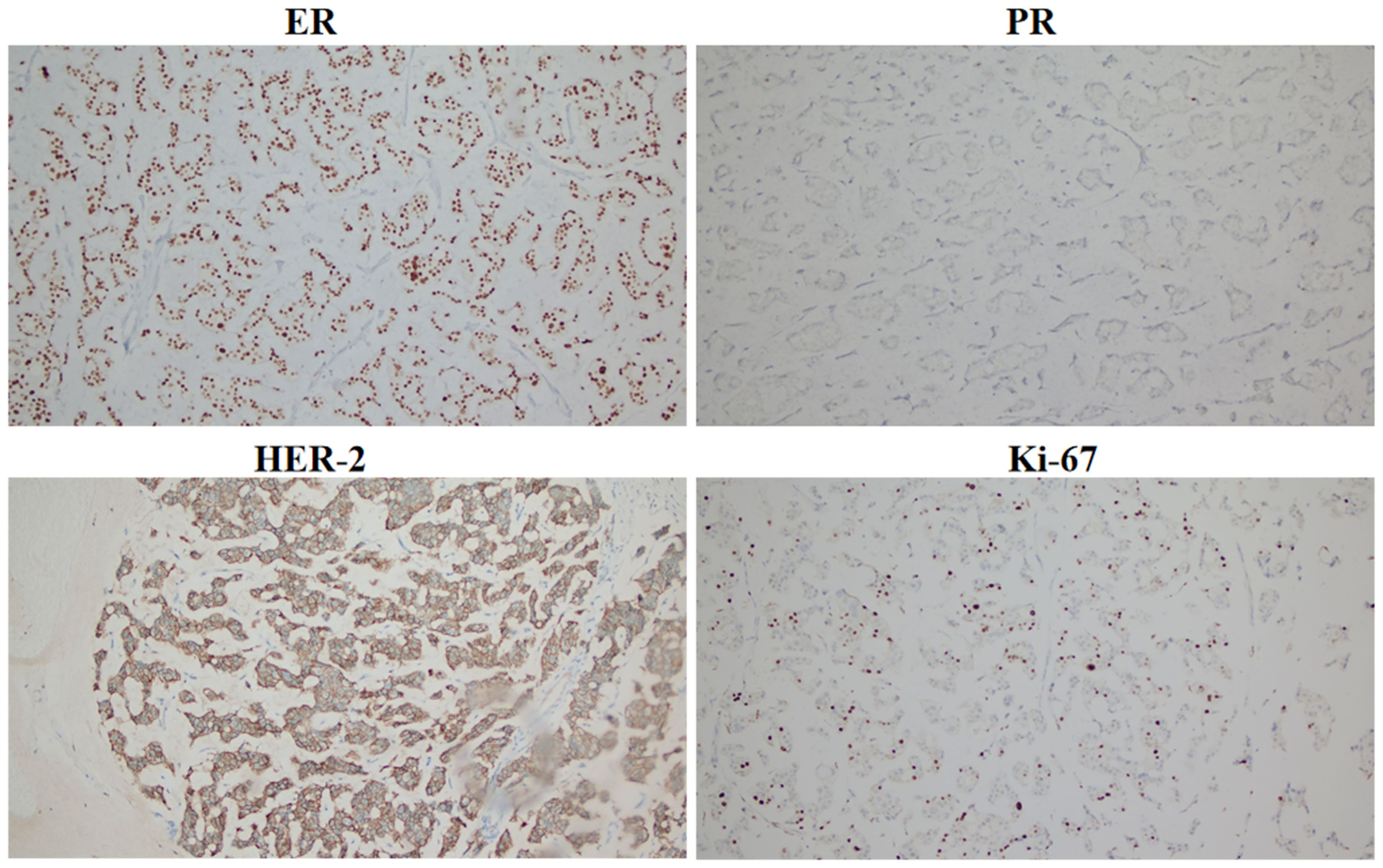 Four panels of immunohistochemical staining images. Top left: ER shows numerous dark brown nuclei. Top right: PR shows faint staining. Bottom left: HER-2 displays strong membrane staining. Bottom right: Ki-67 indicates scattered dark brown nuclei.
