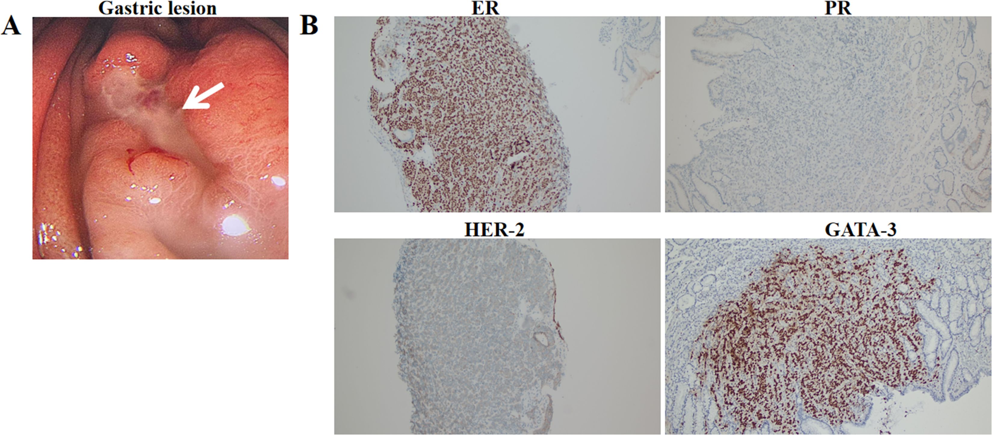 Endoscopic image and histological samples of a gastric lesion. Panel A shows a gastric lesion with an arrow pointing to the area of interest. Panel B displays four histological sections: ER (top left) showing dense staining, PR (top right) with sparse staining, HER-2 (bottom left) with light staining, and GATA-3 (bottom right) with moderate staining.