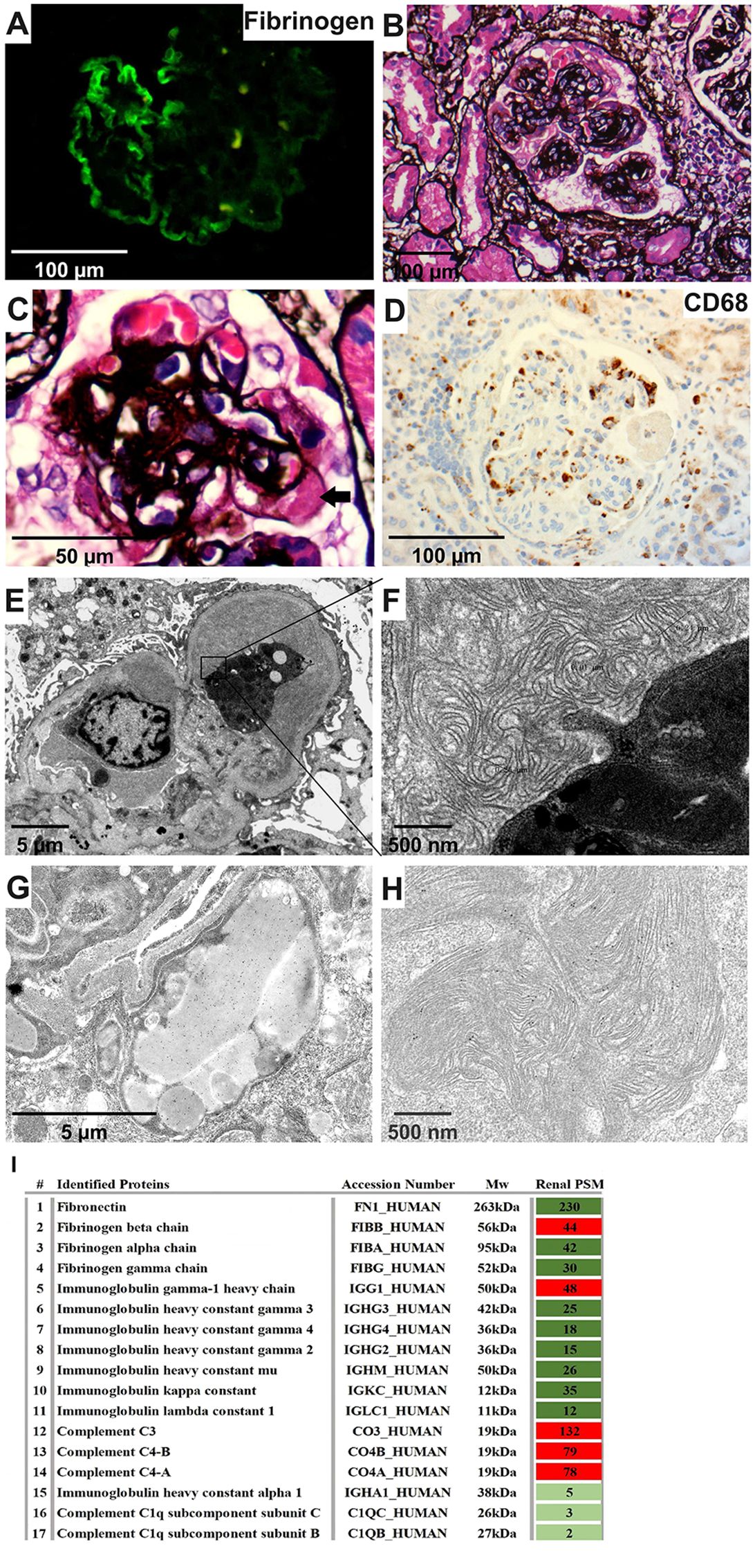 Panel of images showing microscopic and submicroscopic kidney tissue analyses. (A) Fibrinogen stained. (B, C) Stained tissue sections with dark deposits. (D) CD68 stained sample showing cell distribution. (E-H) Electron microscopy images highlighting subcellular structures. (I) Table listing identified proteins, accession numbers, molecular weights, and renal PSM levels with a color-coded scale, ranging from green to red.