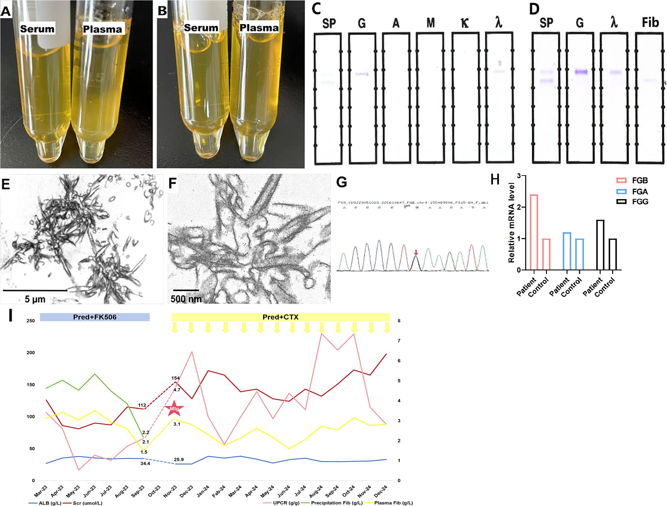 Panels illustrate various analyses related to biological samples and experimental results. Panel A and B show two pairs of test tubes labeled serum and plasma containing light yellow liquids. Panel C and D depict electrophoresis results with distinct bands under labeled sections. Panel E and F are microscopic images showing fibrous structures with different magnifications. Panel G shows a DNA sequencing chromatogram with colored peaks and an arrow indicating a specific point. Panel H is a bar graph comparing relative mRNA levels of FGB, FGA, and FGG between patients and controls. Panel I is a line graph showing various measurements over time.