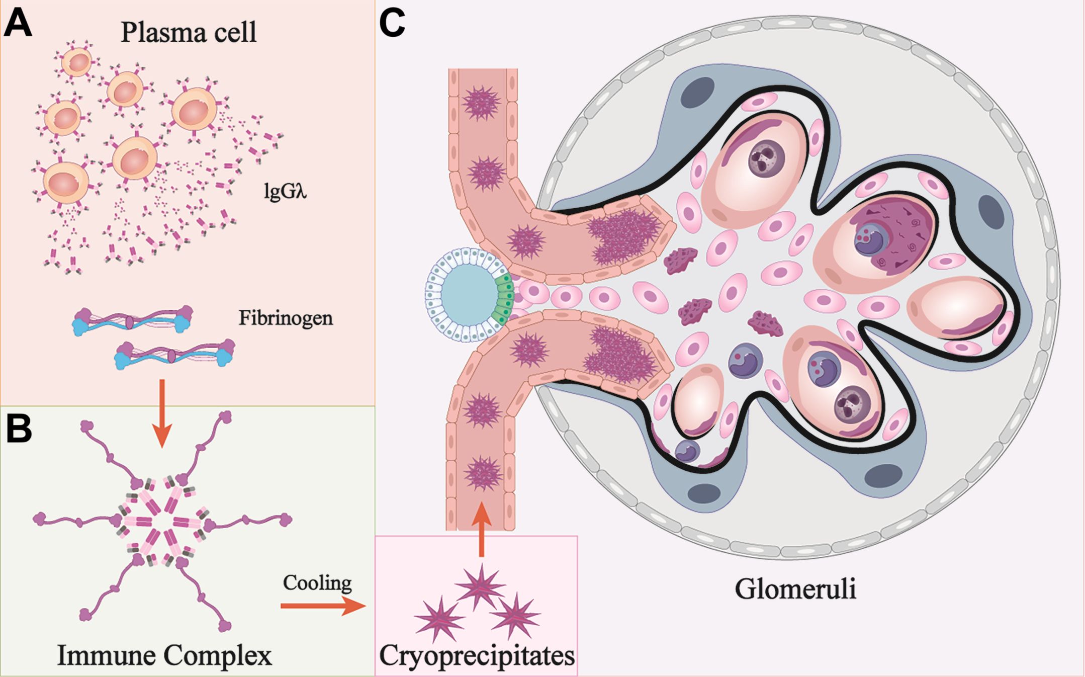 Diagram illustrating the formation of an immune complex and its deposition in a glomerulus. Panel A shows a plasma cell releasing IgGλ and fibrinogen. Panel B depicts the formation of an immune complex, which upon cooling becomes cryoprecipitates. Panel C shows cryoprecipitates depositing in the glomeruli, highlighting their effect on kidney structures.