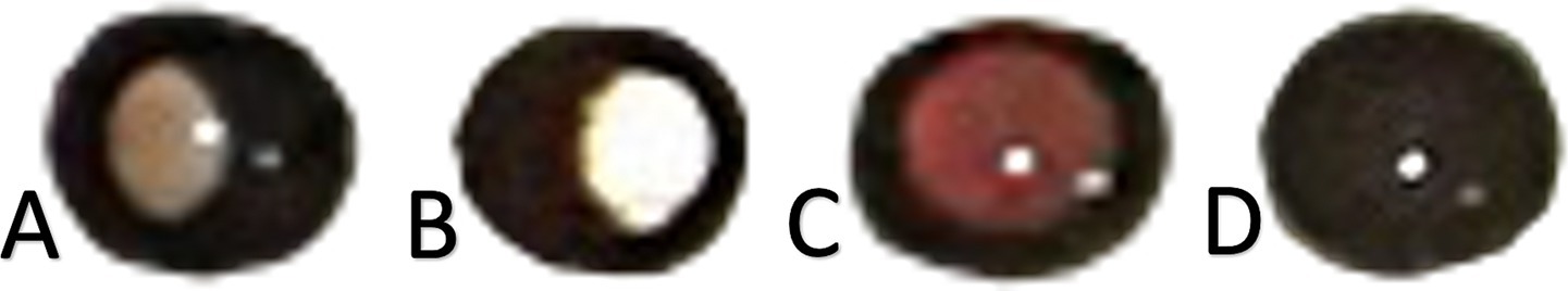 The image displays four examples of cropped photorefractive images, labeled A, B, C, and D, each illustrating different refractive error patterns. Images A and B show distinct crescent-shaped red reflexes, indicative of significant myopia and hypermetropia, respectively. Image C presents a uniform red reflex, characteristic of an insignificant refractive error. Finally, Image D shows an unclear or absent red reflex, categorized as