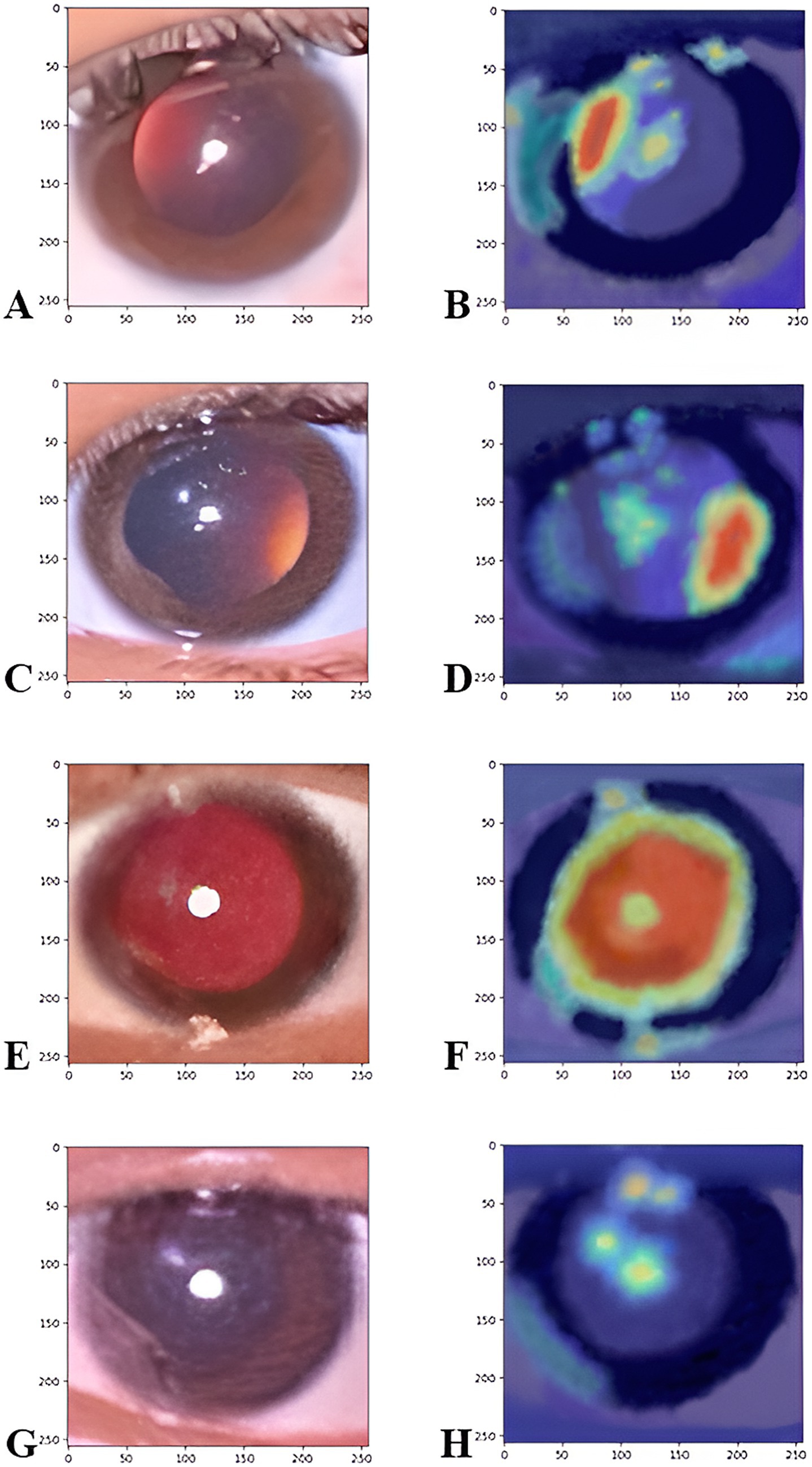 Series of paired images labeled A to H, display Grad-CAM visualizations for different refractive error classifications. Panels A, C, E, and G show original photorefractive eye images. Correspondingly, Panels B, D, F, and H present heatmaps that highlight the regions the model focused on to make its classification. These visualizations provide interpretability by showing which parts of the red reflex patterns and eye features were most influential in determining the presence of significant myopia (A, B), significant hypermetropia (C, D), insignificant refractive error (E, F), and