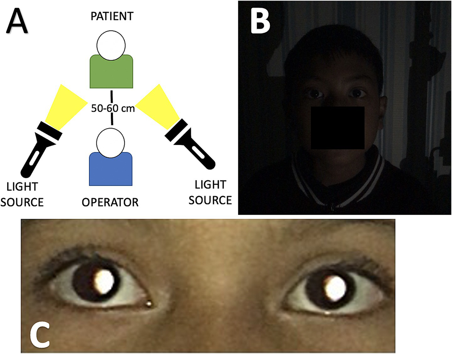 The diagram and accompanying images illustrate the photorefraction image acquisition process. Panel A illustrates the physical setup, showing an operator positioned 50-60 cm from the patient, with two light sources directed towards the patient's eyes. Panel B depicts a smartphone camera capturing the patient's face in a dimly lit environment. Panel C provides a close-up view of the patient's eyes, highlighting the distinct red reflex and crescent-shaped light patterns used for refractive error assessment.