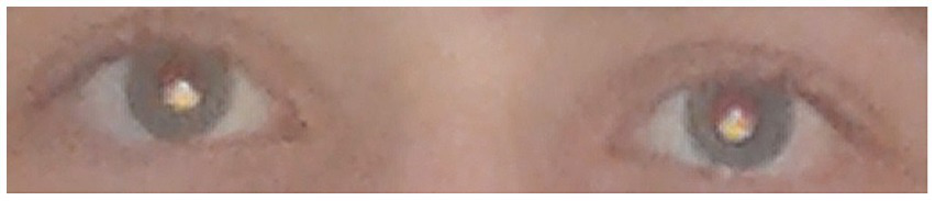 Close-up of a pair of eyes, captured during a photorefraction assessment. In both pupils, a clear crescent-shaped red reflex is visible in the lower portion. These images were specifically acquired using a Samsung Galaxy S3 smartphone, with the light source strategically placed below the camera lens. The distinct crescent pattern of the red reflex is directly influenced by the geometric arrangement of the smartphone camera and its light source during the capture process.