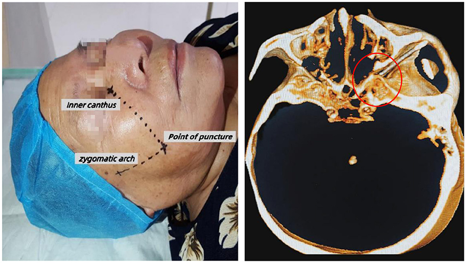 Person lying down with surgical markings labeled “inner canthus,” “zygomatic arch,” and “point of puncture” on the face. Next to it is a CT scan image with a red circle highlighting an area of interest.