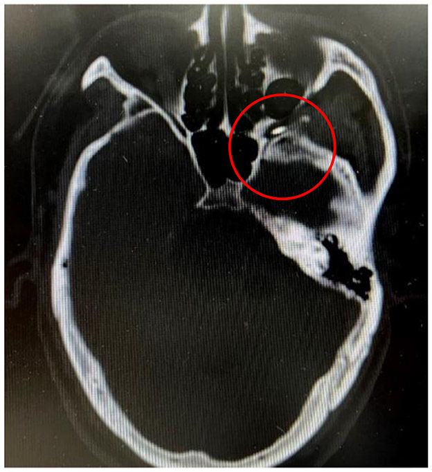 CT scan of a human skull showing a transverse view. A red circle highlights an area of interest on the right side of the image, indicating a specific focus for medical examination.