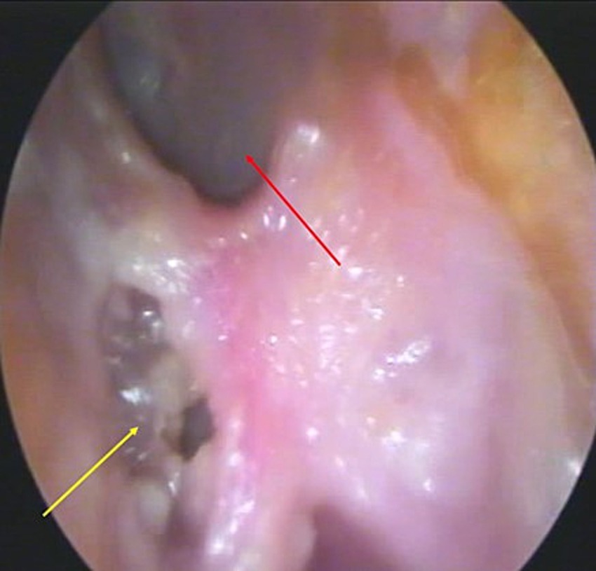 Endoscopic view of the Eustachian tube showing a pinkish tissue surface with a red arrow indicating a specific area and a yellow arrow pointing toward a darkened region.