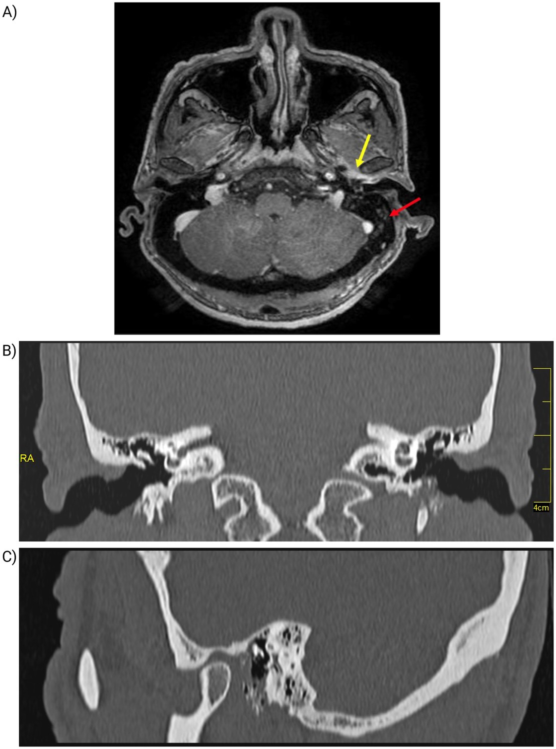 A) MRI cross-sectional image showing the cerebellopontine region with a yellow arrow pointing to a specific area and a red arrow indicating another spot. B) CT coronal section of the ear structures labeled “RA,” displaying detailed inner ear anatomy. C) CT coronal section emphasizing the middle ear and surrounding bone structures.
