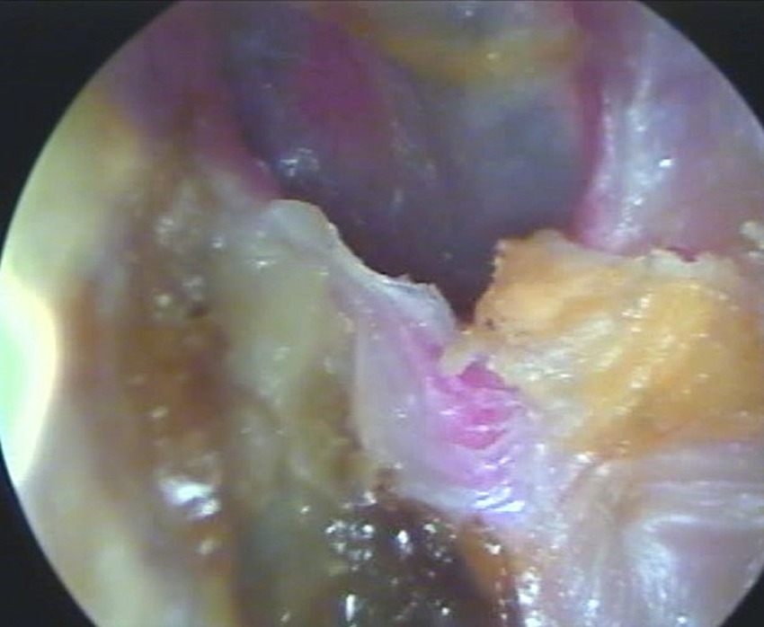 Endoscopic view inside a human ear canal, showing detailed structures with variations in color and texture. Pinkish, yellow, and brown areas are visible, likely representing different tissues and earwax.