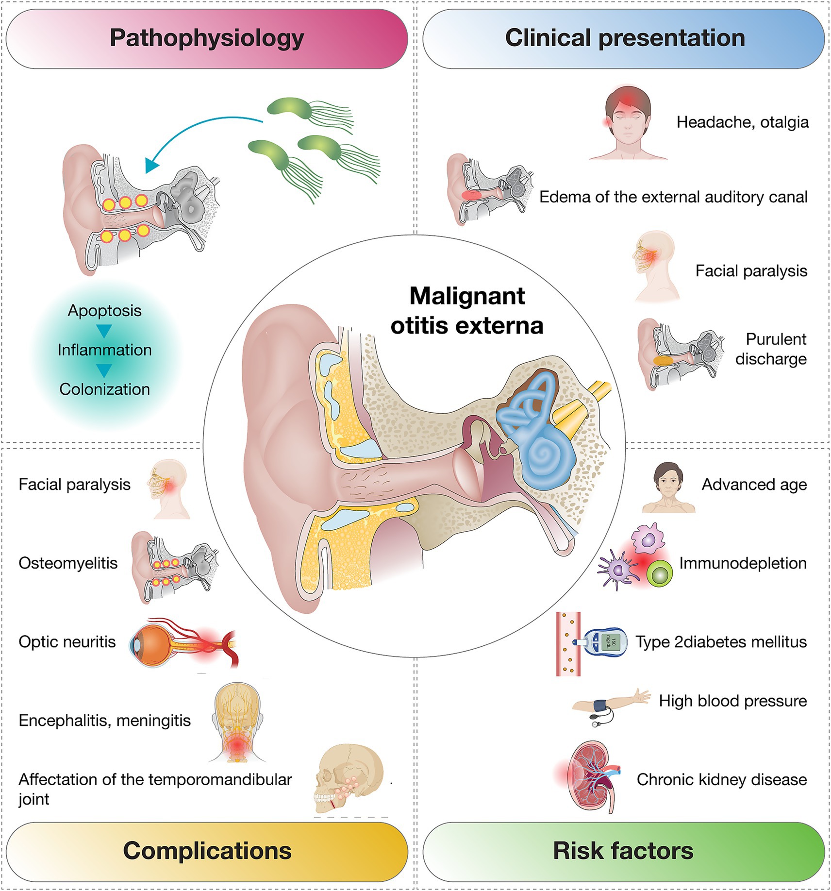 Diagram illustrating malignant otitis externa, featuring four sections: pathophysiology, clinical presentation, complications, and risk factors. The pathophysiology section shows bacterial colonization leading to apoptosis and inflammation. Clinical presentation includes headache, ear pain, facial paralysis, ear canal edema, and discharge. Complications noted are facial paralysis, osteomyelitis, optic neuritis, encephalitis, meningitis, and temporomandibular joint issues. Risk factors include advanced age, immunodepletion, type 2 diabetes, high blood pressure, and chronic kidney disease. The main visual is a detailed cross-section of the ear.