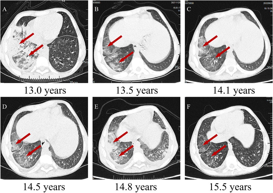 CT scan series showing lung images at different ages: 13.0, 13.5, 14.1, 14.5, 14.8, and 15.5 years. Red arrows highlight areas of interest in the lungs, indicating changes over time.