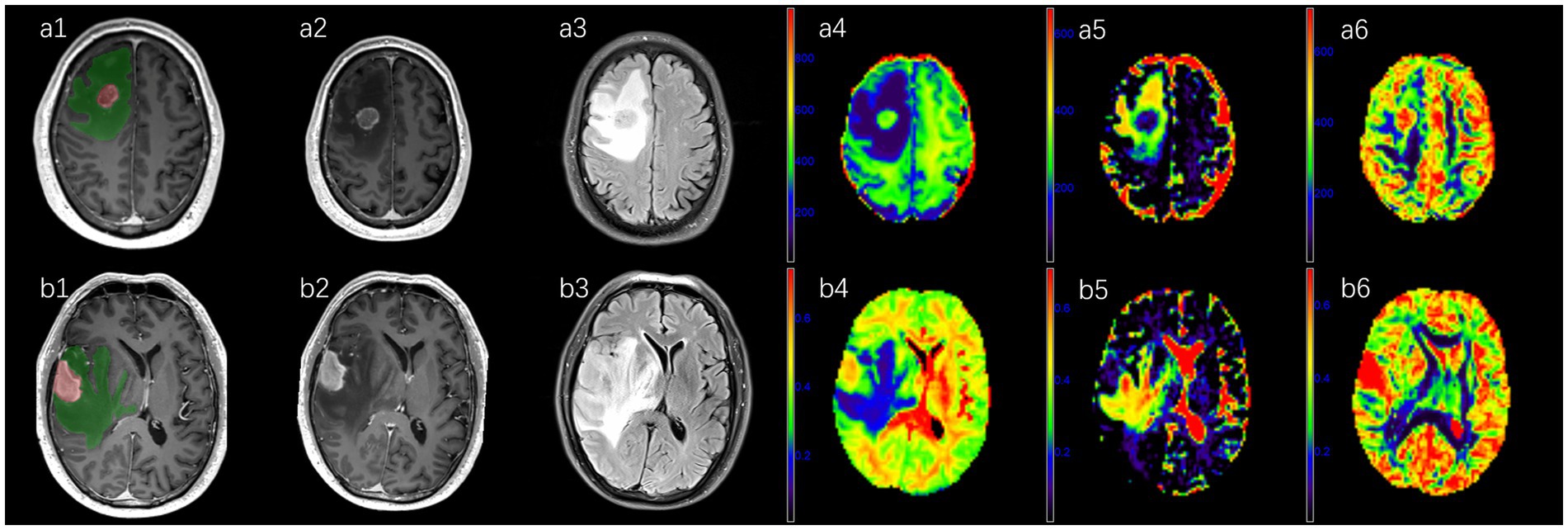 MRI scans show two rows of brain images. The top row (a1-a6) includes images a1 to a3 in grayscale with color-highlighted regions, suggesting abnormalities. Images a4 to a6 use a heat map color scheme, indicating different data or metrics. The bottom row (b1-b6) mirrors this pattern, with b1 to b3 in grayscale and highlighted sections, and b4 to b6 as heat maps. Each set seems to represent different views or conditions for comparison.