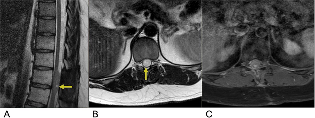Three MRI scans showing different views of the spine. Image A is a sagittal view highlighting a possible disc issue with a yellow arrow. Image B is an axial view showing a cross-section of the spine with a yellow arrow pointing to an area of interest. Image C is another axial view without annotations.