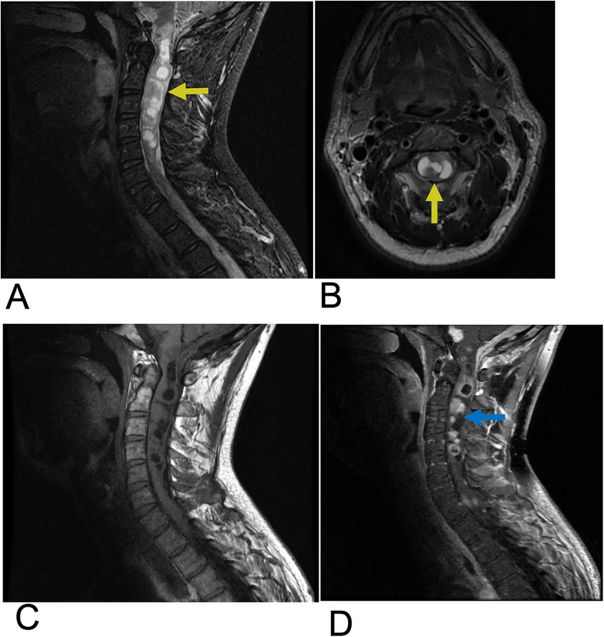 MRI images of the cervical spine in four panels. Panel A shows a sagittal view with a yellow arrow indicating a lesion in the cervical region. Panel B provides a transverse view with a yellow arrow pointing to the lesion. Panel C is a sagittal view without markings. Panel D highlights the same region with a blue arrow indicating another area of interest.