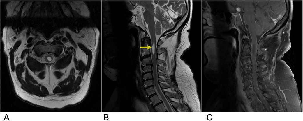 MRI scans of the cervical spine in three panels. Panel A shows a transverse view, Panel B shows a sagittal view with a yellow arrow pointing at the C2-C3 level, and Panel C shows another sagittal view with contrast enhancement.