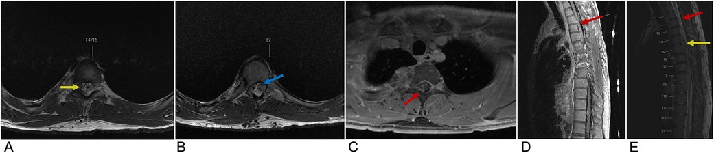 MRI images showing different views of the thoracic spine from vertebrae T4/T5 to T11/T12. Image A highlights a region in the T4/T5 area with a yellow arrow. Image B points to the T7 area with a blue arrow. Image C shows the T11/T12 area marked by a red arrow. Image D features a red arrow indicating the T2/T3 region. Image E highlights the T4 area and T2 region with yellow and red arrows.
