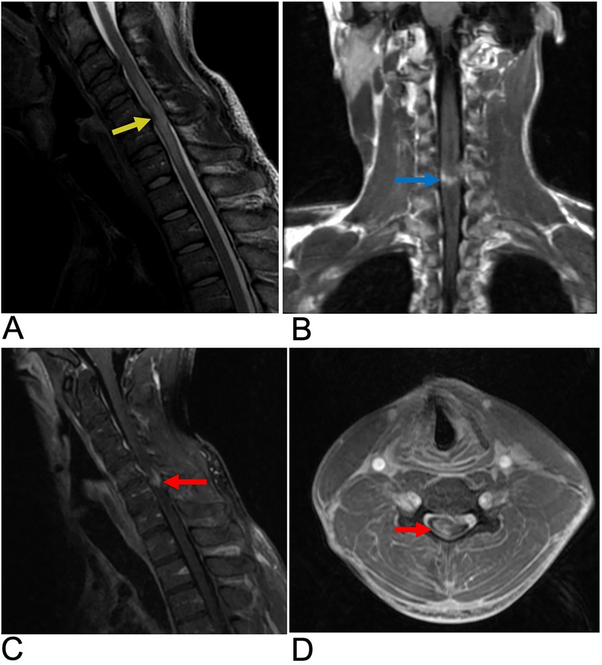 MRI scan showing four views of the cervical spine. Image A shows a sagittal view with a yellow arrow indicating a lesion. Image B displays a coronal view with a blue arrow marking a different area of interest. Image C presents another sagittal view with a red arrow highlighting a lesion. Image D offers an axial view with a red arrow pointing to a specific structure.