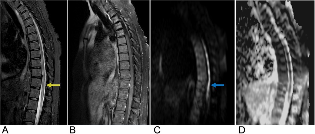 MRI images of the thoracic spine in four panels labeled A to D. Panel A shows a sagittal T2-weighted image with a yellow arrow indicating a lesion at the T10 level. Panel B presents a sagittal T1-weighted image highlighting the same area. Panel C features a diffusion-weighted image with a blue arrow pointing to the lesion. Panel D is an apparent diffusion coefficient (ADC) map corresponding to the same region.