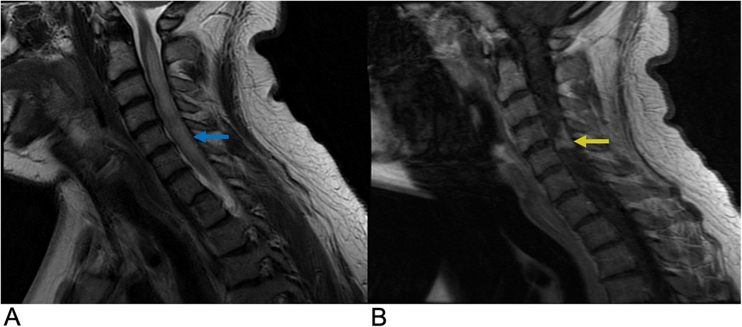 Sagittal MRI scans of the cervical spine with two images labeled A and B. Image A shows a blue arrow pointing to a disc protrusion. Image B shows a yellow arrow pointing to a decrease in disc herniation compared to A.