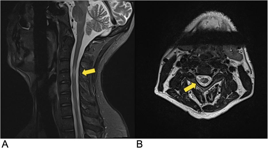 MRI images of the cervical spine. Image A shows a sagittal view with a yellow arrow pointing to a region in the spinal cord. Image B displays an axial view with a yellow arrow indicating a similar area.