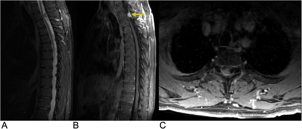 MRI scans of the thoracic spine in different views. Image A shows a sagittal section, Image B highlights a spinal lesion at the T2 level with an arrow, and Image C offers a transverse section, revealing spinal structures.