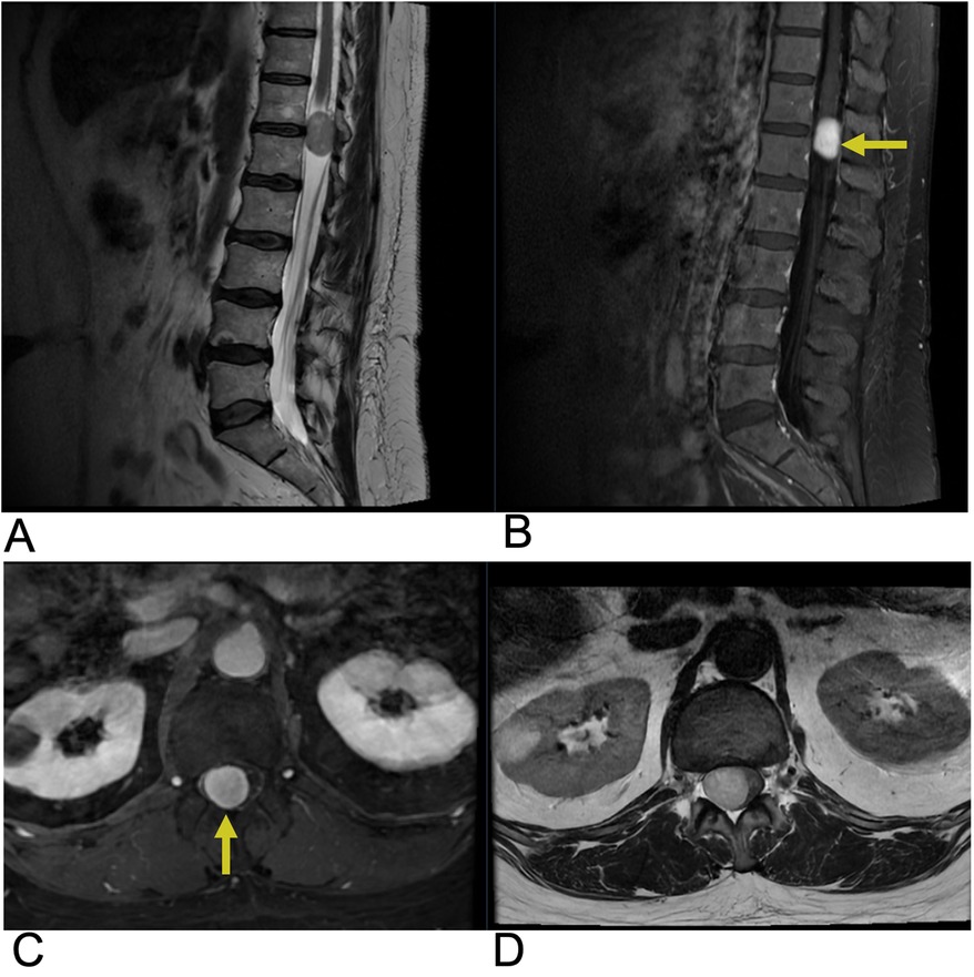 MRI images of the spine in sagittal and axial views. Image A shows the normal spinal structure. Image B, with an arrow, highlights a bright circular lesion. Image C, in an axial view, also with an arrow, indicates a similar lesion. Image D displays the corresponding axial section without the highlighted lesion.