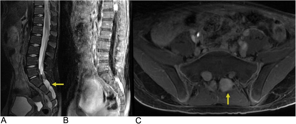 MRI images showing three different views of the lumbar spine. Image A and B display sagittal views with a yellow arrow highlighting an abnormality at the lower lumbar region. Image C presents an axial view with a yellow arrow indicating a similar area of interest.