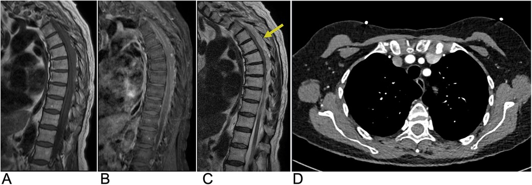 MRI and CT images of the spine and chest. Image A shows a normal sagittal view of the spine. Image B depicts an abnormality in the same view. Image C has a yellow arrow highlighting a lesion. Image D is a transverse CT scan of the chest revealing structures and potential abnormalities.