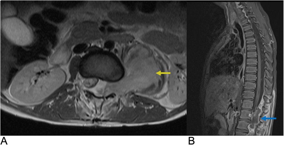 MRI scans showing two images: (A) an axial view of the abdomen with a yellow arrow indicating a highlighted area, possibly a lesion or abnormality. (B) a sagittal view of the spine with a blue arrow pointing to a specific vertebra, suggesting an area of interest or concern.