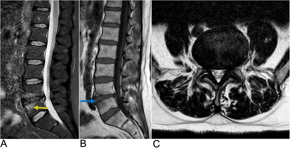 MRI images showing lumbar spine sections. Image A illustrates a sagittal view with a yellow arrow indicating a specific disc herniation. Image B is another sagittal view with a blue arrow pointing to a different herniation. Image C provides an axial view, highlighting disc positioning and adjacent structures.