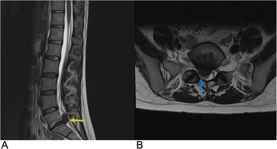 Image A shows a sagittal MRI of the lumbar spine, highlighting a disc herniation at the L5-S1 level with a yellow arrow. Image B is an axial MRI of the lumbar spine, with a blue arrow indicating the herniation at the same level.
