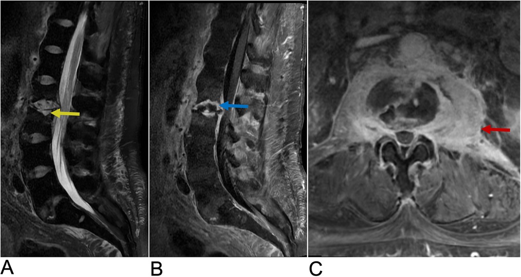 MRI images showing three different views. Panel A displays a sagittal view with a yellow arrow indicating a highlighted spinal area. Panel B shows another sagittal view with a blue arrow pointing to a particular spinal region. Panel C presents an axial view with a red arrow highlighting an area of interest.