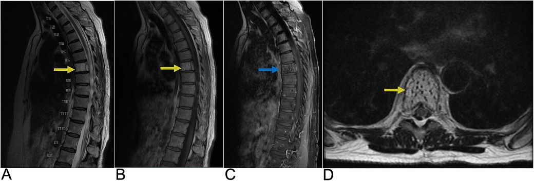 MRI scans of a lumbar spine in four views labeled A, B, C, and D. Image B has a yellow arrow pointing at the L3 vertebra, indicating a specific area of interest. Images depict varying contrast levels.