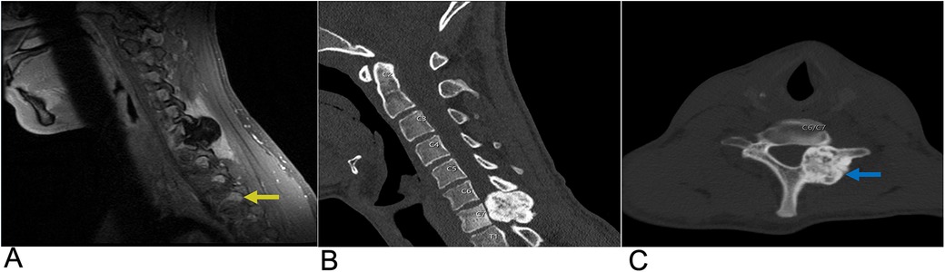 MRI images of the thoracic spine in sagittal (A, B, C) and axial (D) views. Yellow arrows highlight lesions or abnormalities in the T7 vertebra area, while the blue arrow in image C indicates another point of interest. Images are labeled A through D.