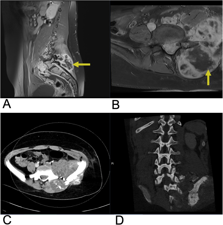 MRI and CT scans of the cervical spine in three panels. Panel A shows a sagittal MRI with a yellow arrow highlighting a lesion. Panel B displays a sagittal CT scan, marking vertebral levels. Panel C shows an axial CT scan with a blue arrow pointing to a lesion at the C6/C7 level.