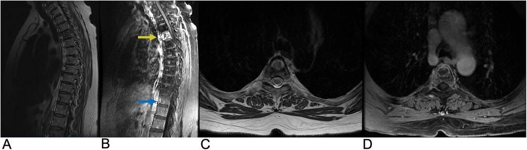 Panel A shows a sagittal MRI with an arrow pointing to a spinal abnormality. Panel B is an axial MRI highlighting a mass near the spine. Panel C is a CT scan of the abdomen in the axial view. Panel D displays a coronal CT of the spine with visible vertebrae.
