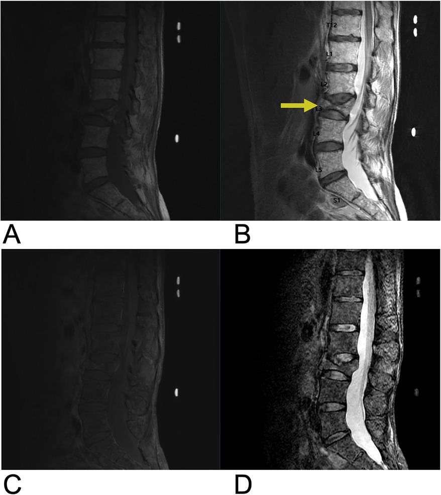 MRI scans labeled A, B, C, and D display different views of the thoracic and lumbar spine. Image A shows a sagittal view with vertebrae labeled from C6 to L2. Image B highlights areas with yellow and blue arrows, indicating T4 and T11. Images C and D present axial views of the spine, revealing cross-sectional details.
