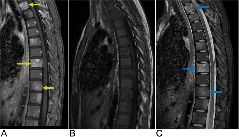 MRI images of the thoracic spine in three panels labeled A, B, and C. Panel A shows areas with yellow arrows pointing to specific vertebrae. Panel B is a standard view without highlights. Panel C has blue arrows indicating different vertebrae.