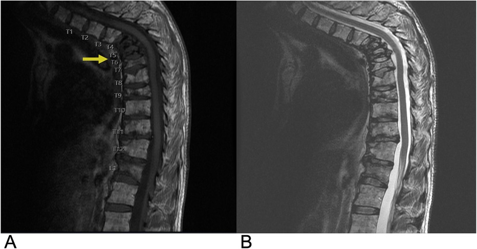 MRI images of the thoracic spine in sagittal view labeled A and B. Image A shows vertebrae T1 to L1, with a yellow arrow indicating a lesion at T6. Image B shows the same region post-treatment, with clearer spinal alignment and less visible lesion.