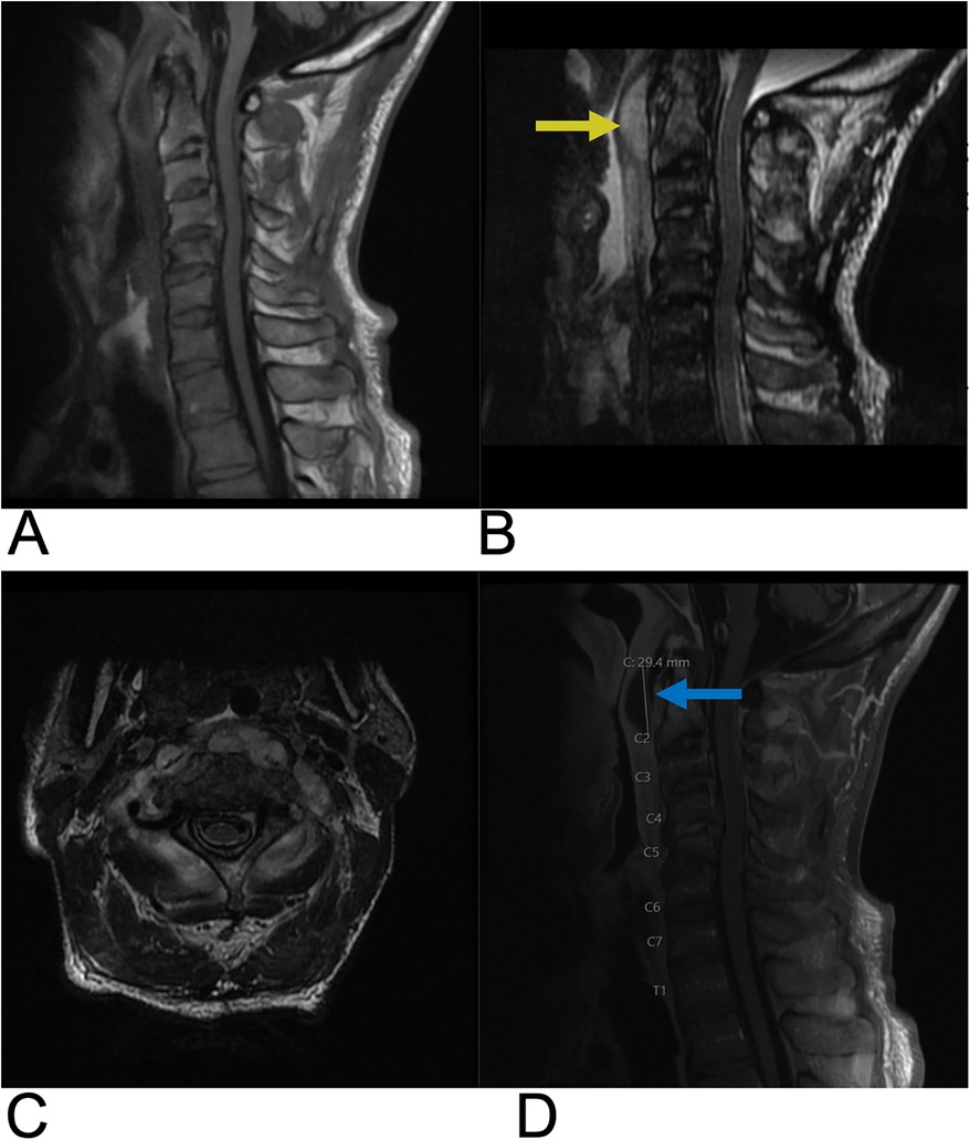 MRI composite of the cervical spine in four panels. Panel A shows a sagittal view of the cervical vertebrae. Panel B highlights an issue with a yellow arrow. Panel C presents an axial view. Panel D, with a blue arrow, marks a measurement of 29.4 millimeters, with vertebrae labeled C2 through T1.