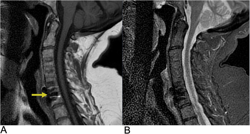 MRI images of the cervical spine. Image A shows a herniated disc at a vertebral level with a yellow arrow pointing to the affected area. Image B shows a cross-sectional view of the same region without annotations.