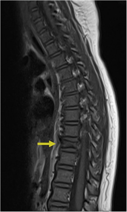 MRI scan of the spine showing sagittal view. A yellow arrow points to an area along the spinal column that may indicate an abnormality or point of interest, such as a herniated disc or spinal compression.