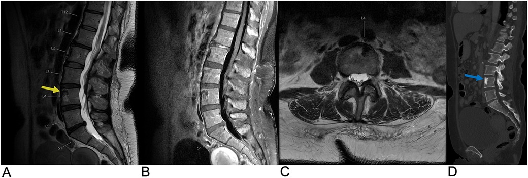 MRI and CT images of the lumbar spine show various views. Image A highlights the L4 vertebra with a yellow arrow. Image B provides a closer lateral view. Image C presents an axial view at L4. Image D shows a CT scan with a blue arrow pointing to a feature in the lumbar region. The images are labeled A to D.