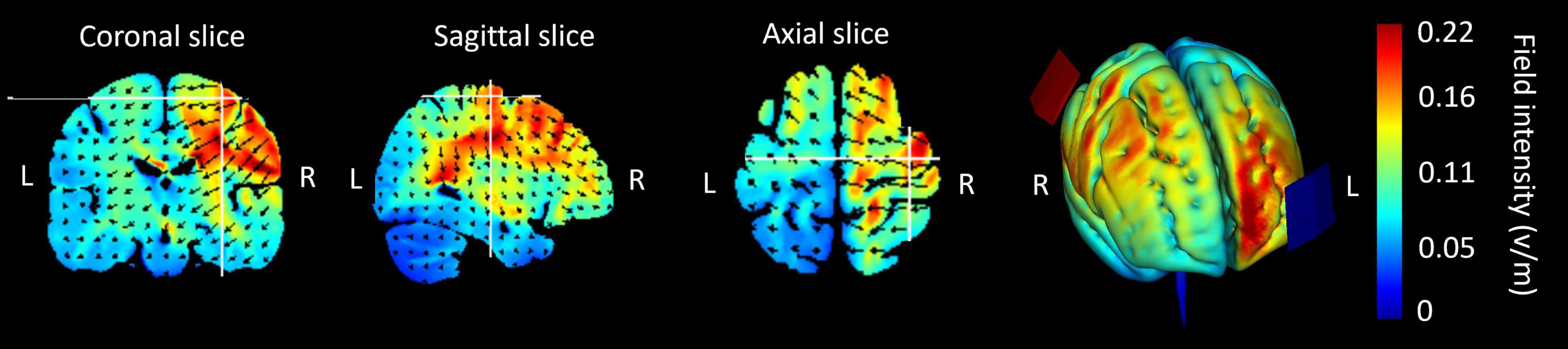 Brain scans showing electric field intensity in coronal, sagittal, and axial slices. Colors range from blue (low intensity) to red (high intensity), with a scale on the right indicating field intensity from zero to 0.22 volts per meter.