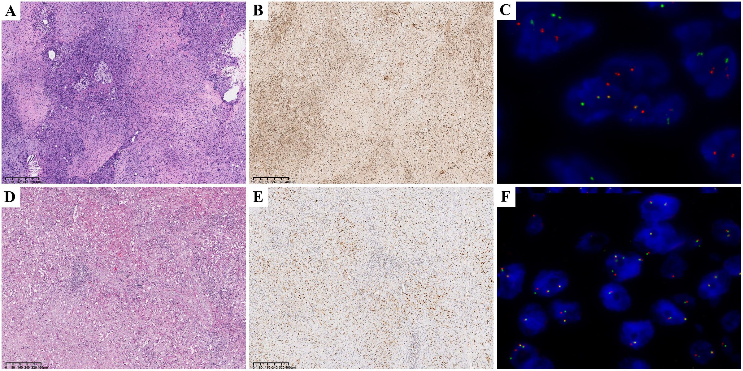 Microscopic histological and fluorescent images are arranged in two rows. Panels A and D show histological stains with varying cell densities and patterns. Panels B and E show immunohistochemical stains highlighting specific cellular markers. Panels C and F display fluorescent in situ hybridization (FISH) images with blue cellular nuclei and red and green signals indicating specific genetic markers. Scale bars are present for reference.